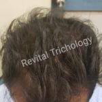 Hair Problem Mumbai