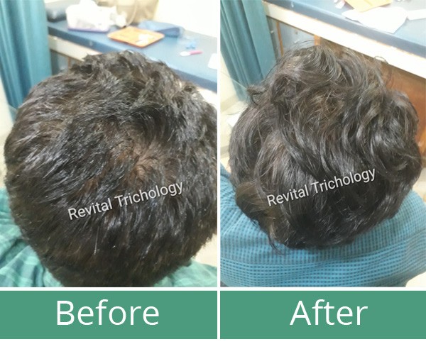 Before and after for hair loss