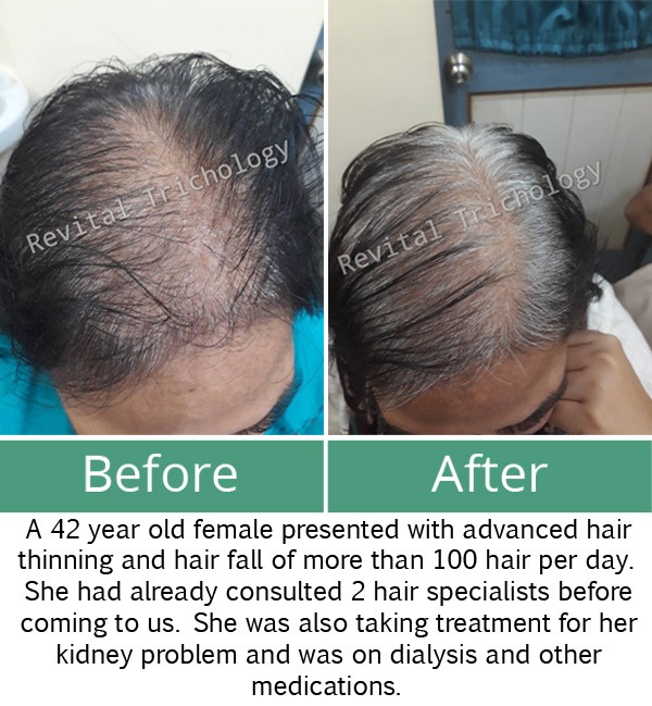 Case study Hair loss