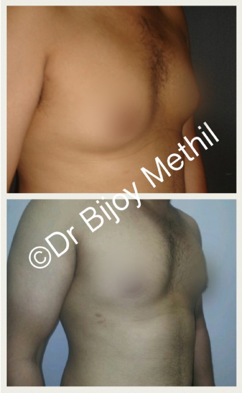 Male Breast Lift Reduction Before And After