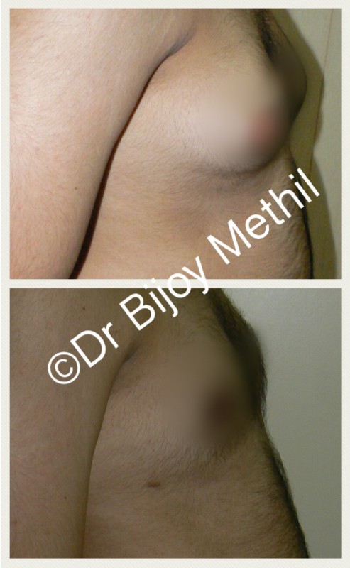 Male Breast Lift Reduction Before And After